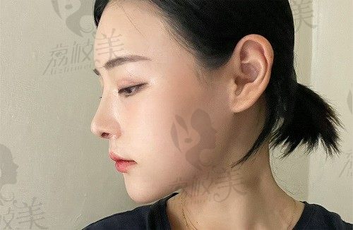 找韩国优雅人朴哲佑做的肋骨鼻太棒了，术后拥有绝美立体翘鼻