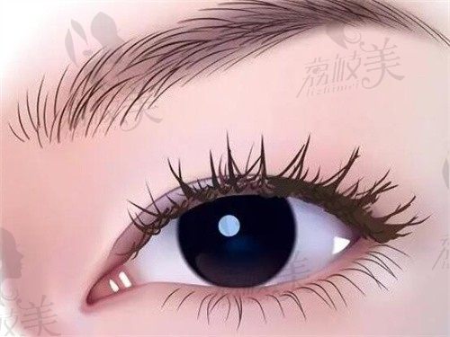 西安徐文云TAO定制美眼综合价格9.8k起，肿泡眼上睑肌无力均可改善