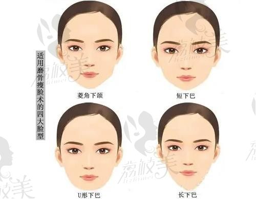 赵贵庆是上海9院出来的，磨骨/改脸型/颧骨内推技术靠谱可在线预约
