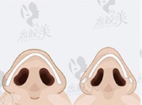 武汉同济叶子荣做鼻子拥有自然妈生感，疑难鼻修复价格35000元起