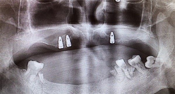 看牙可以讲价钱吗？别吐槽看牙怎么那么贵手把手教你省钱攻略