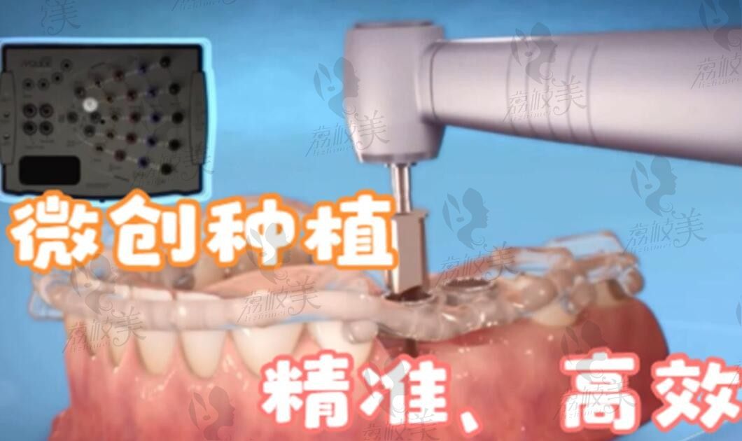 上海哪些医院可以做微创种植牙？上海微痛种植牙医院排名及价格分享