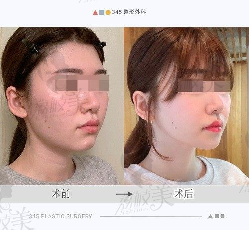 韩国345整形医院轮廓成效太哇塞，术后脸型立体小巧显瘦十斤！