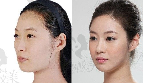 来看韩国BK整形外科轮廓眼鼻最新反馈，风格自然秒变氧气美女