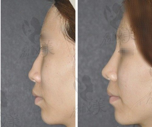 韩国will整形医院鼻修复技术好赞，改善了困扰我二十多年的畸形驼峰鼻