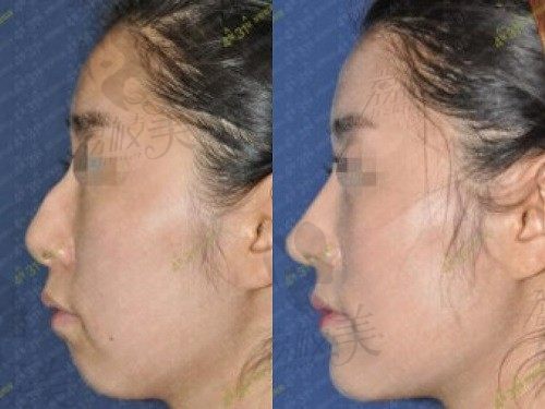 韩国431整形外科鼻修复技术靠谱，畸形鼻也能变流畅自然高挺鼻