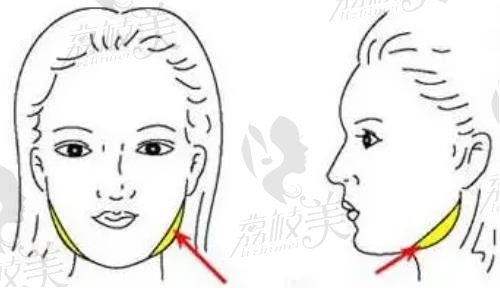 武汉下颌角整形医院排名：这些医院具备四级高难度手术正规资质很靠谱