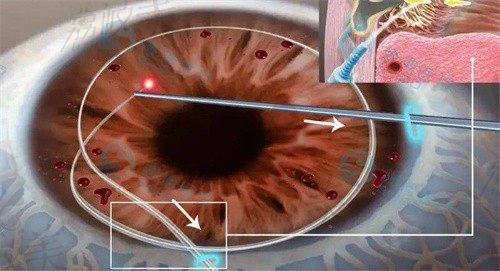 青光眼是什么原因引起的,能通过手术治愈吗？激光手术价格多少