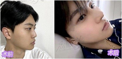 韩国优雅人整形外科隆鼻实例分享，男生也可以拥有精致的翘鼻