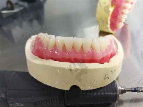 覆盖义齿修复是什么意思？想知道它和固定义齿种植牙的区别