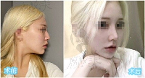 韩国优雅人隆鼻技术怎么样？出血量少/恢复周期短/术后鼻子自然线条流畅