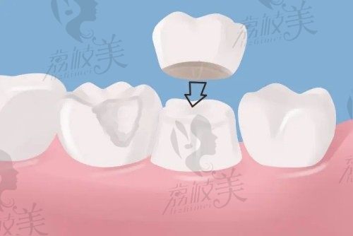 台州博雅口腔医院种植牙多少钱?韩国进口种植牙4500元起很实惠