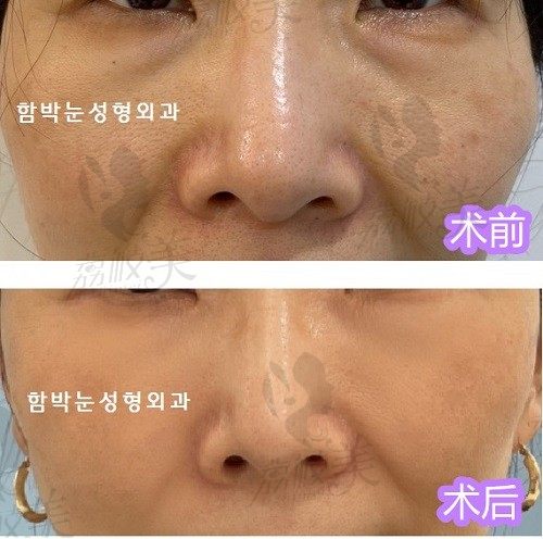 韩国大眼睛整形外科下眼睑提升实力很强，中年妇女的福音年轻十岁不是梦