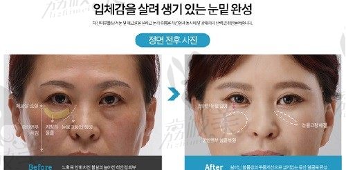 韩国大眼睛医院下眼睑提升术太棒了，术后快速还原年轻态