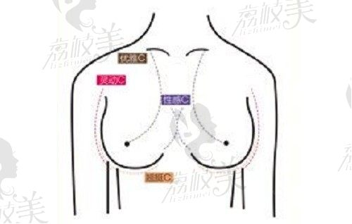 北京美莱高超隆胸价格不贵：娴熟的内窥镜假体隆胸术只要32580起