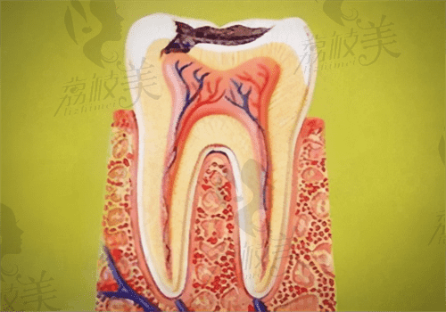 自测牙齿是否烂到牙神经，几种方式教你辨别还送处理办法