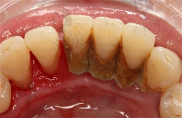 牙周发炎引起的牙齿松动需怎样治疗？做牙周刮治可以固定牙齿吗