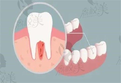 牙周炎牙龈萎缩牙齿松动怎么办？其实牙周炎治疗后也能做种植牙
