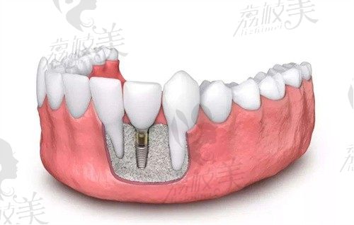 良心牙医告诉你,不是每个人都可以种植牙,种植牙的条件提前告知