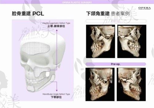 韩国欧佩拉医院pcl补骨效果真的好，术后一年变成了自己的骨骼！   