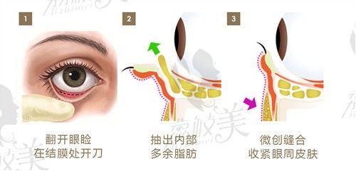 祛眼袋内切好还是外切好?眼袋手术有风险吗会不会有后遗症