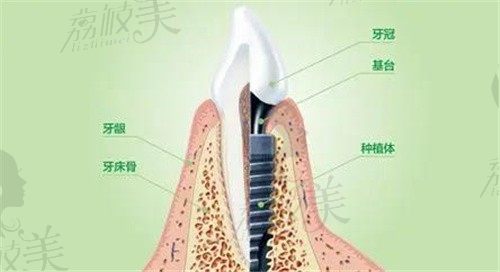 南京溧水金铂利口腔种牙价格:集采一颗1k起半口种植牙价格1.8万