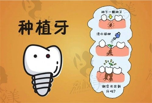 昆明口腔医院种植牙的费用全公开，看柏德/美奥/尚爱韩美哪家更实惠