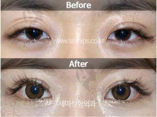 韩国世美医院眼修复术后分享，眼睛灵动又有神简直美翻了