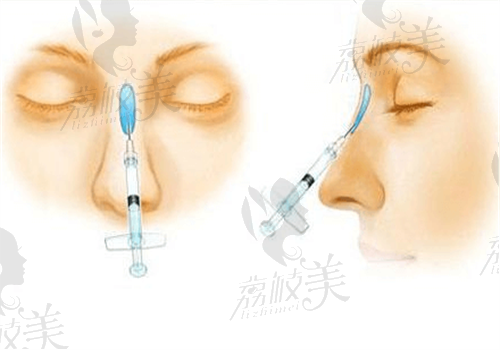 2023医美行业最新玻尿酸隆鼻手术价格表清单,杭州不同医院价格对比
