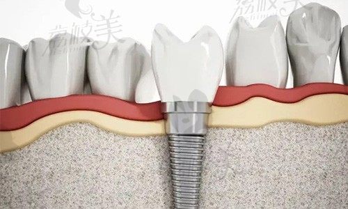 武汉种植牙价格表：种植牙一颗2600/半口25000/全口8万元起