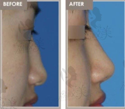 韩国心美眼医院鼻修复全过程，驼峰鼻术后变得很流畅   