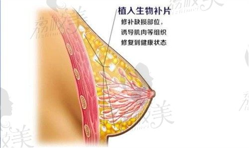 西安国医李高峰做乳房重建4w起,定制三型双平面内窥镜隆胸