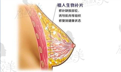 西安國醫(yī)李高峰做乳房重建4w起,定制三型雙平面內(nèi)窺鏡隆胸