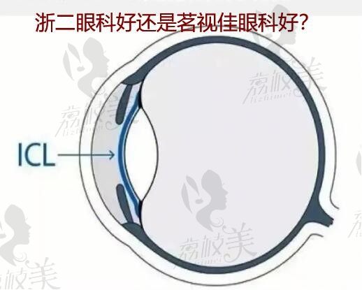 杭州做晶体植入哪个医院好点？​排名中浙二眼科好还是茗视佳眼科好？
