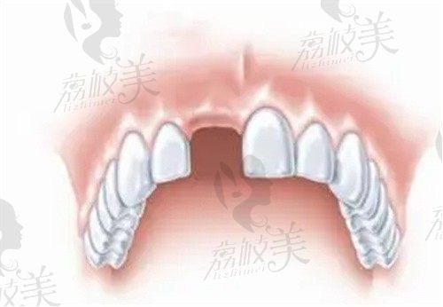 上门牙缺失一颗怎么办?种植牙/烤瓷牙/活动牙三种修复方法别选错
