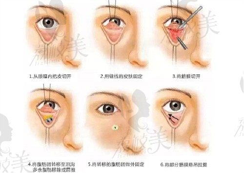 祛眼袋整形手术多少钱？外切3k起内切5k起眶隔释放4k起