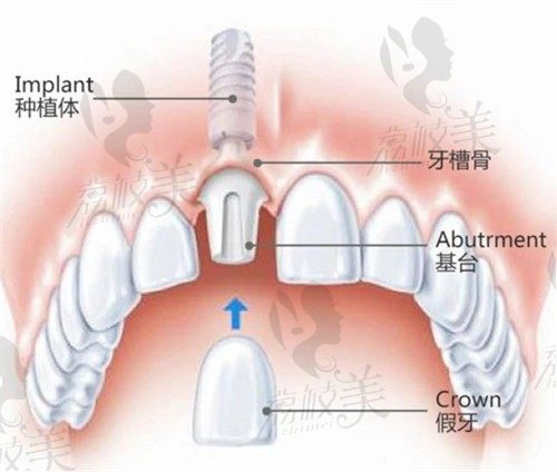 沈阳种植牙技术推荐榜公布，医院医疗水平、设备、医生经验都有