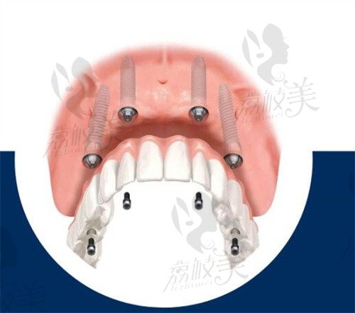 广州团圆口腔数字化微创种植技术,马建元德国卡瓦ABT种牙6800元/颗起