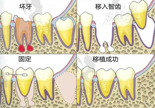 自体牙移植技术成熟吗？自体牙移植与种植牙优势PK附费用参考