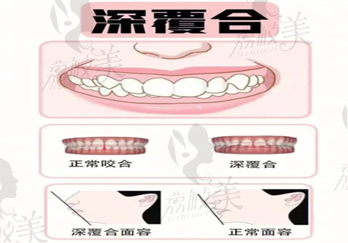 重庆牙齿深覆合矫正费用多少,整理得知重庆深覆合牙齿矫正20000+