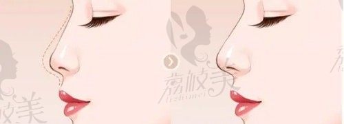 北京联合丽格整形宫风勇是自然派隆鼻先行者,半肋鼻综合价格5.2w元起