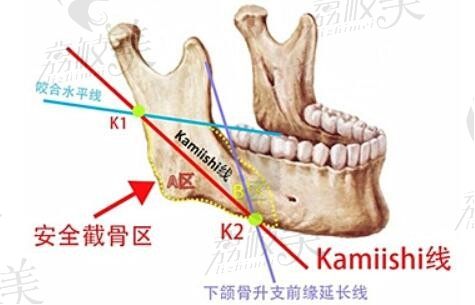 柳超现在在广州韩妃整形医院，做下颌角截骨3W+很靠谱可预约挂号