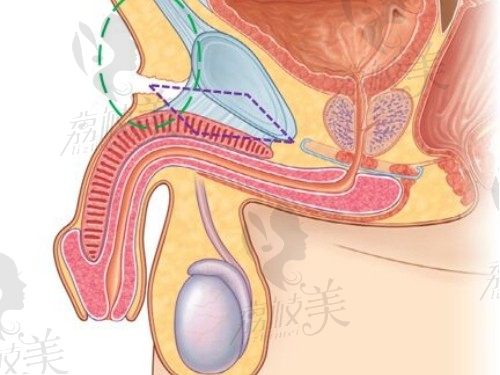 男性阴茎延长手术方法有几种?3种阴茎延长手术治疗法重拾男人雄风（医院推荐）