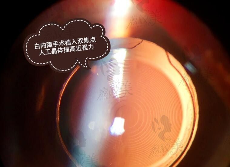 南宁普瑞眼科医院是正规三级眼科，刘泉医生双焦点人工晶体2万起