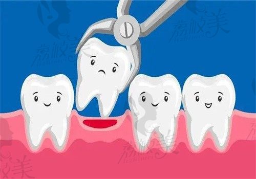 蛀牙最多能拖多久？引发原因以及治疗方式等一文知晓