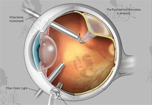 视网膜脱落手术是大手术,术前须知晓手术成功率/风险/费用