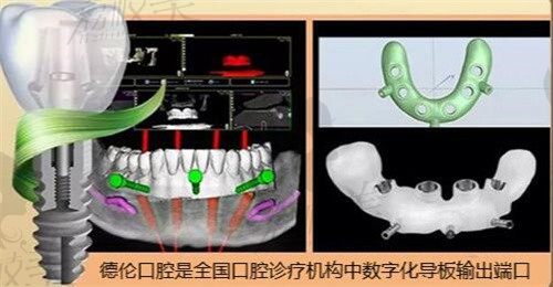 广州德伦口腔罗朝阳精通各类复杂种植技术,3D数字化种牙快价格实惠!