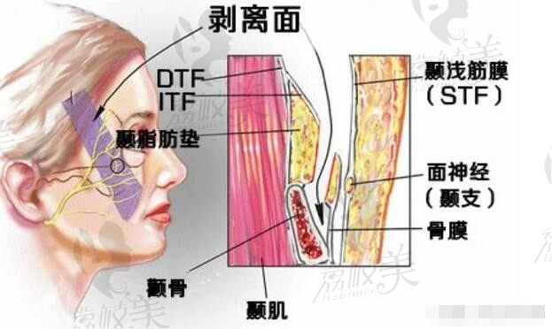 微拉美4.0是什么原理？价格是多少钱？听说效果维持时间在2~3年