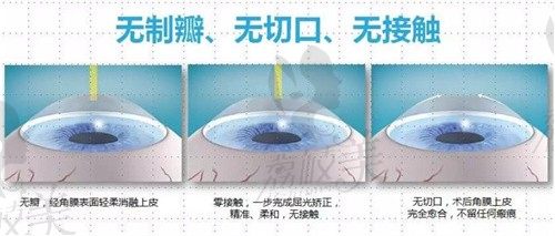 2024全国各地全飞秒激光手术价格汇总,北上广深等费用不同