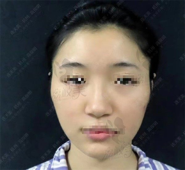 手术前